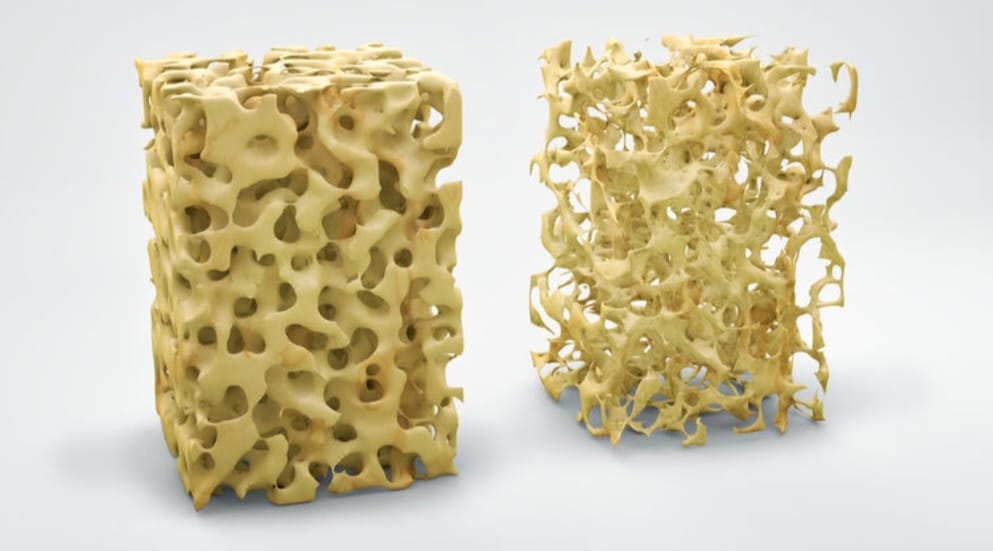 אוסטאופורוזיס