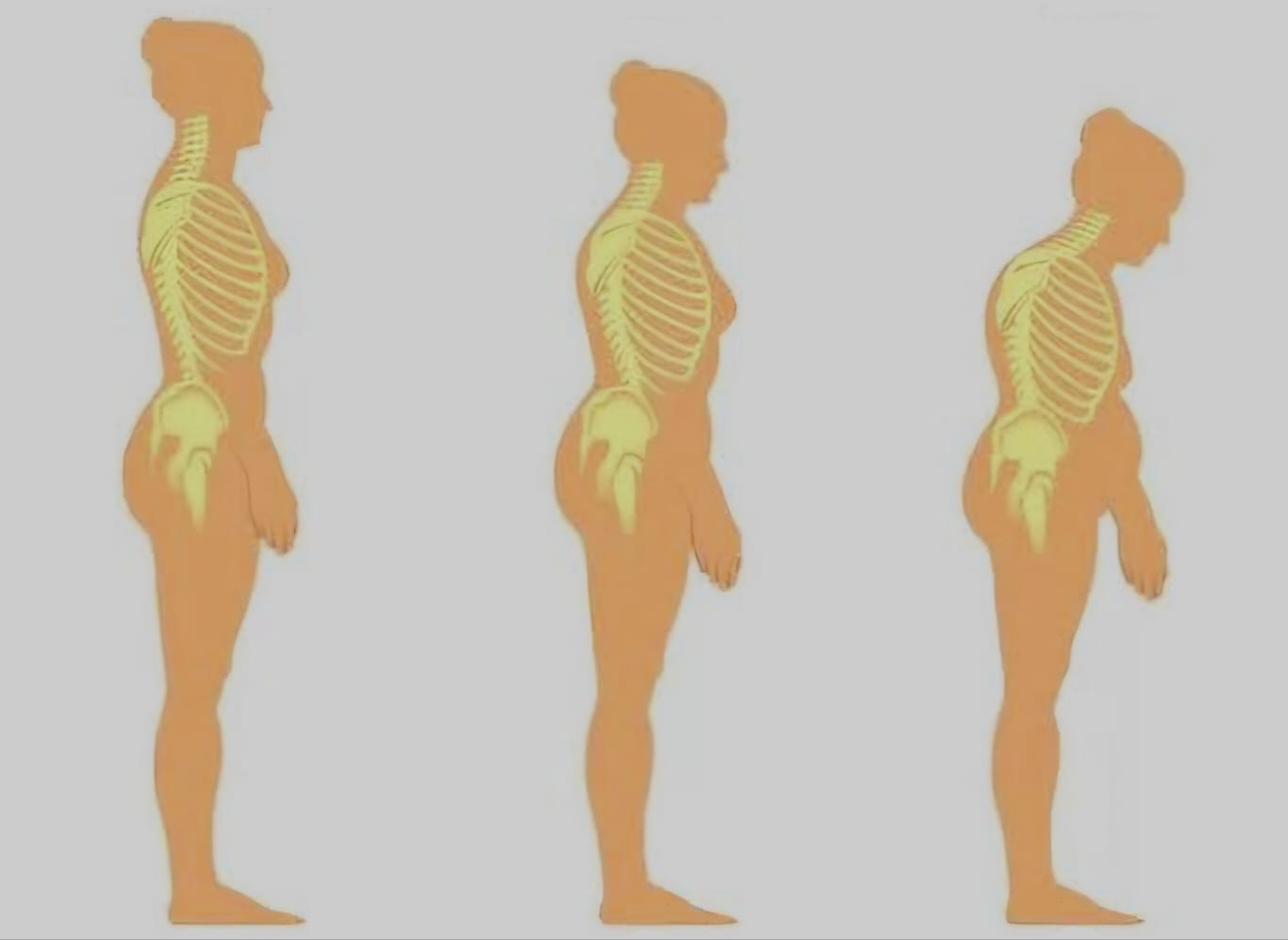 גיל מעבר אצל גברים
  אוסטאופורוזיס
  